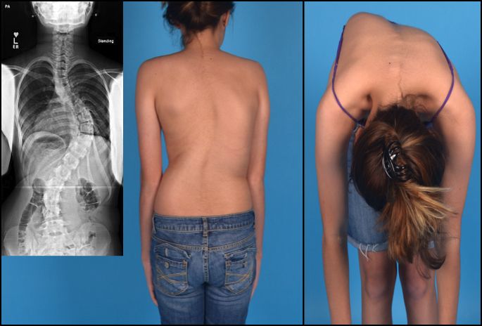 scoliosis