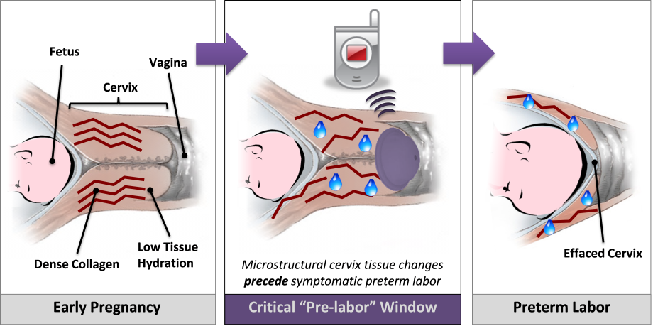 The Problem: Preterm Birth | Smart Diaphragm | UCSF