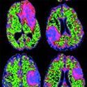 MRI Tumor Scans